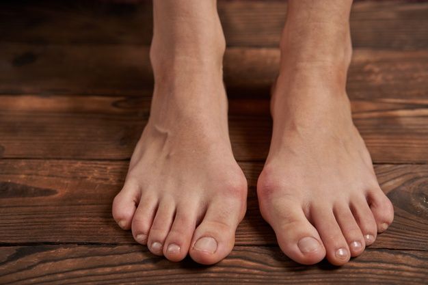 Signs and Symptoms of bunions